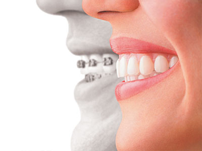 Invisalign and Braces in White Marsh