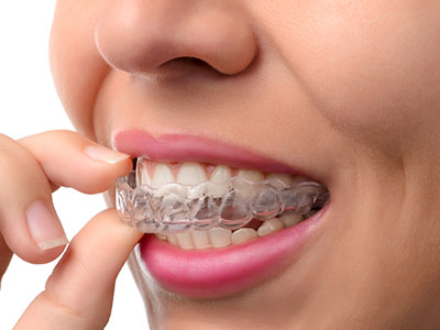 Invisalign near me