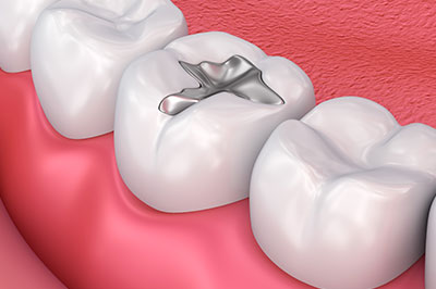 White Marsh Amalgam Fillings