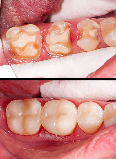 Composite Fillings in White Marsh