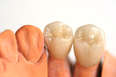 Dental Crowns in White Marsh