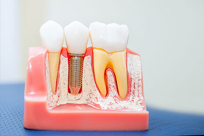 Dental Implants in White Marsh