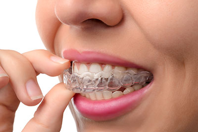 Invisalign in White Marsh