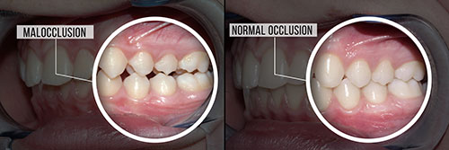 Malocclusion in White Marsh