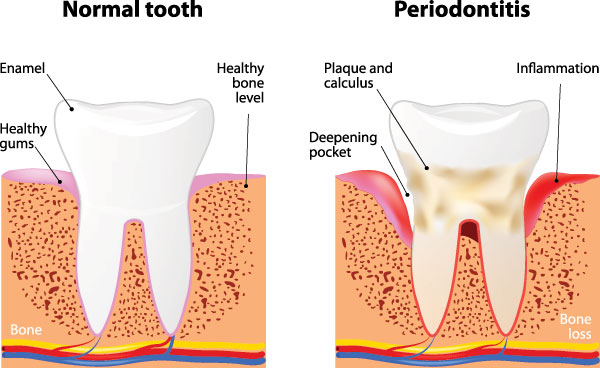 Periodontal Treatment in White Marsh