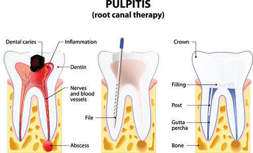 White Marsh Root Canal Treatment