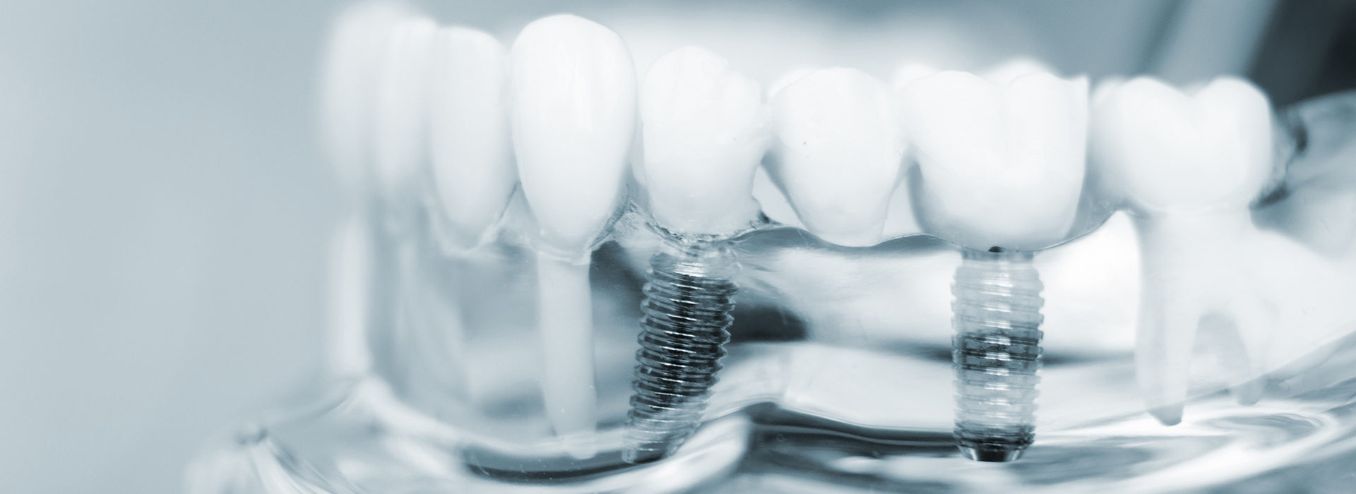 Implant Dentist White Marsh
