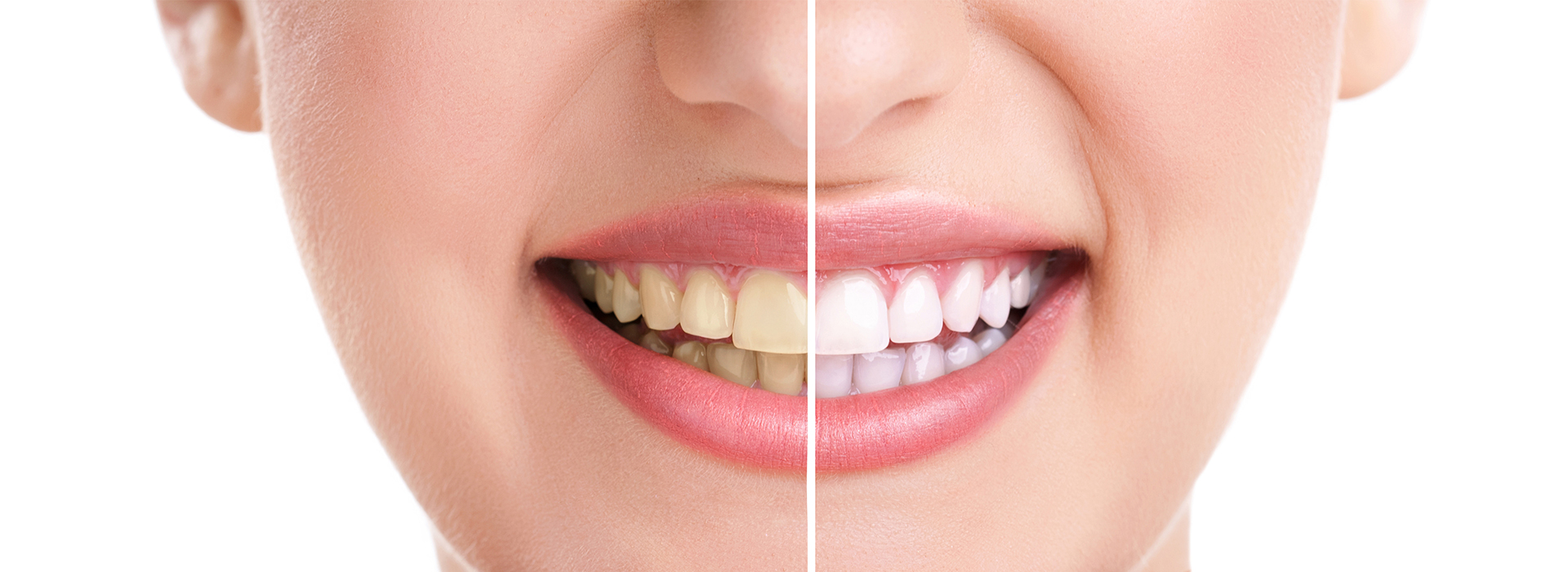 Teeth Whitening in White Marsh