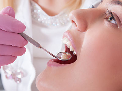 Dental Fillings in White Marsh